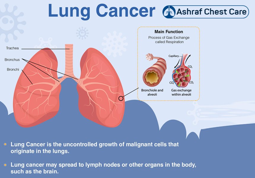 Ashraf Chest Care Hospital